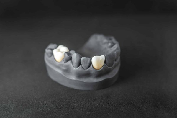 Avez-vous des solutions pour les dents manquantes à Saint-Jean-sur-Richelieu ?